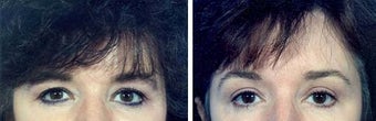 Belpharoplasty before 643231