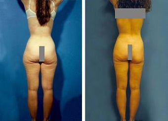 Liposuction before 636234