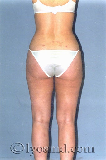 Liposuction after 225378