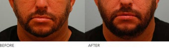 Lip Reduction/Lip Correction before 136743