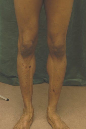 Men's Calf Augmentation 519061