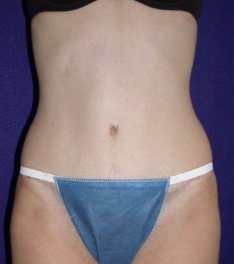 Tummy Tuck (abdominoplasty) after 208475