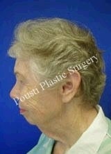 Chin Implants, Dermabrasion, Face Lift, Forehead Lift, Neck Lift 622586