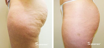 Velashape, after 5 treatments before 45489