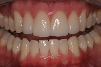Porcelain Crowns after 332541