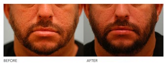 Lip Reduction/Lip Correction after 136743