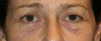 Fraxel Laser before 129994
