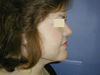 Neck Liposuction after 93325