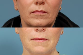 Sculptra area around mouth before 409236