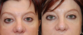 Silikon-1000 to correct lower eyelid irregularities after blepharoplasty before 127327