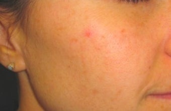 IPL for Acne after 374388