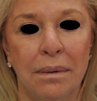 TCA Full-Face Chemical Peel after 182429