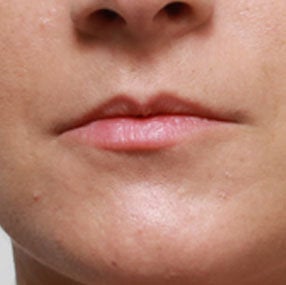 Non Surgical Lip Enhancement before 549863