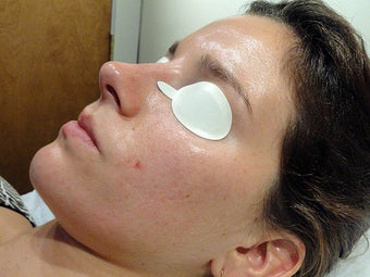 Acne Treatment via Isolaz after 570309