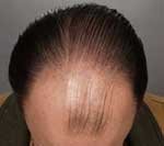 Hair Transplant before 426677