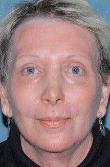 Laser resurfacing treatment for wrinkles after 376154