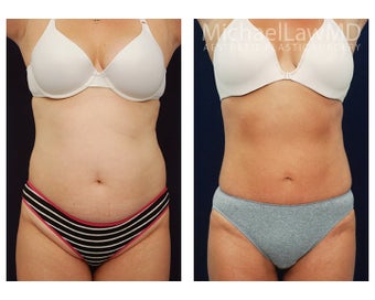 Liposuction before 495015