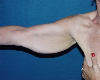 Brachioplasty before 118257