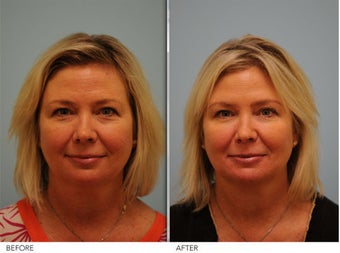 Short Term Botox before 350399