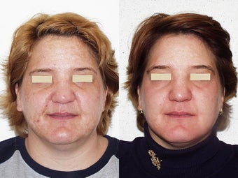 Clay Masque Treatment before 96287