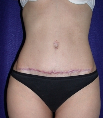 Tummy Tuck (abdominoplasty) after 208471