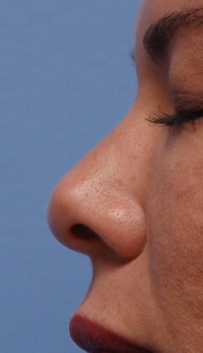 Non-Surgical Rhinoplasty before 182604