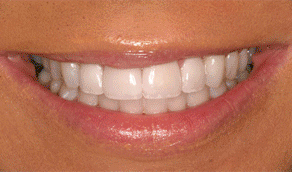 Whitening after 385392