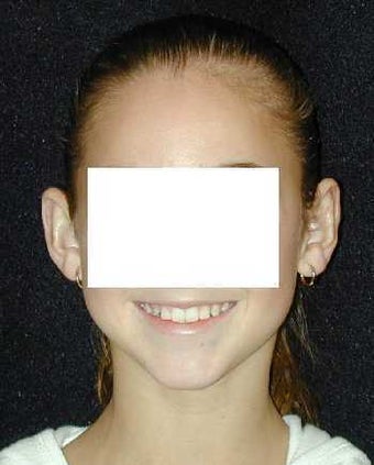 Otoplasty - Ear Surgery after 215188