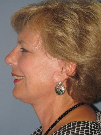 Neck Lift, Platysmaplasty 634747
