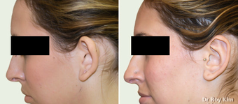 Otoplasty-Ear Surgery before 277814