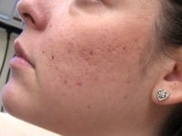 Acne/Acne Scars Treatment with Smoothbeam after 272003