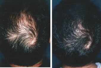 Medical treatment for hair loss (no surgery) before 369180