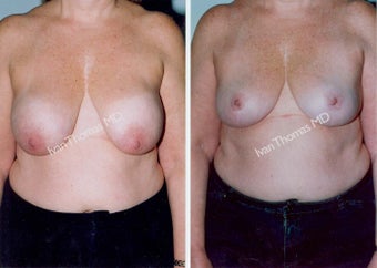 Implant removal and Breast lift before 243648