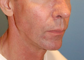 Jaw Augmentation w/ Mandibular Implants before 166195