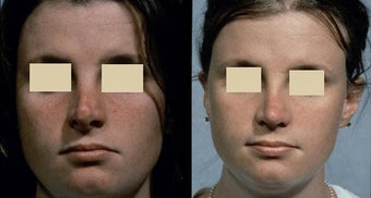 Revision Rhinoplasty before 127039