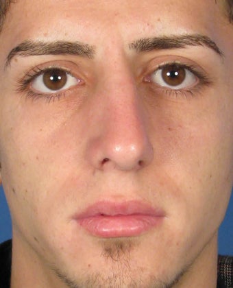 Rhinoplasty before 400983