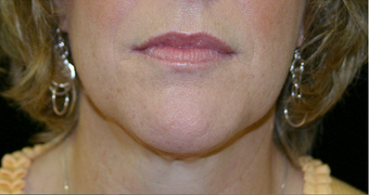 neck liposuction after 238511
