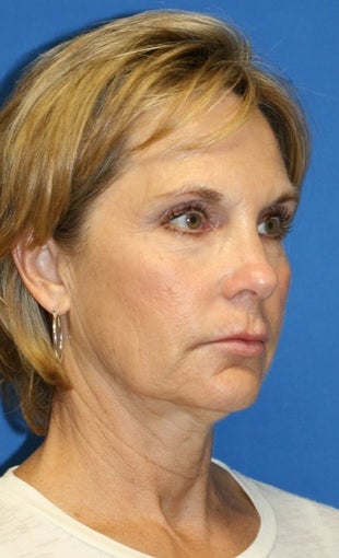 face Lift 367610