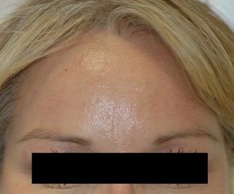 Dysport Injections Orange County Before and After after 349211