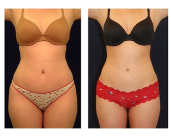 Liposuction before 286745