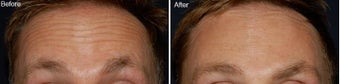 Botox for forehead lines before 97867