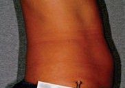 Liposonix 582710