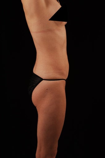 Liposuction after 513558
