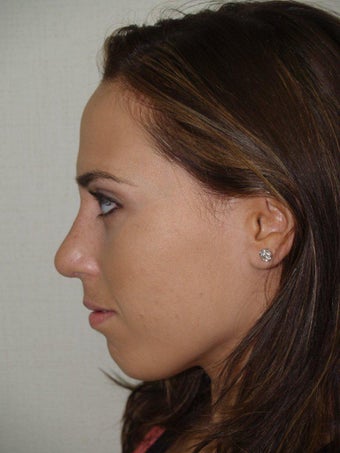 Rhinoplasty after 229068