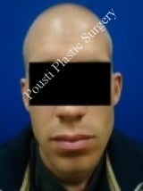 Ear Surgery (Otoplasty) 616669