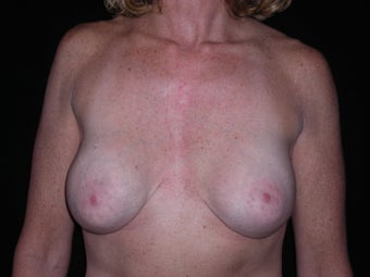 Removal and replacement of breast implants and breast lift before 237757