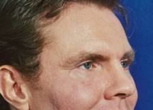 Facial Fat Grafting after 75986