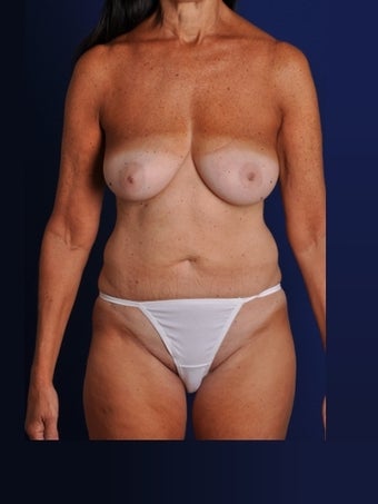 Vaser Hi Def Liposuction of abdomen, thighs, flanks and back with fat injections to buttocks before 422729