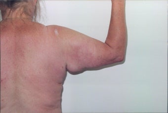Arm lift before 216940