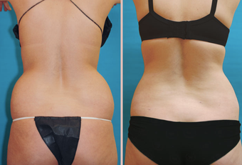 Back / Waist Lipo before 293421